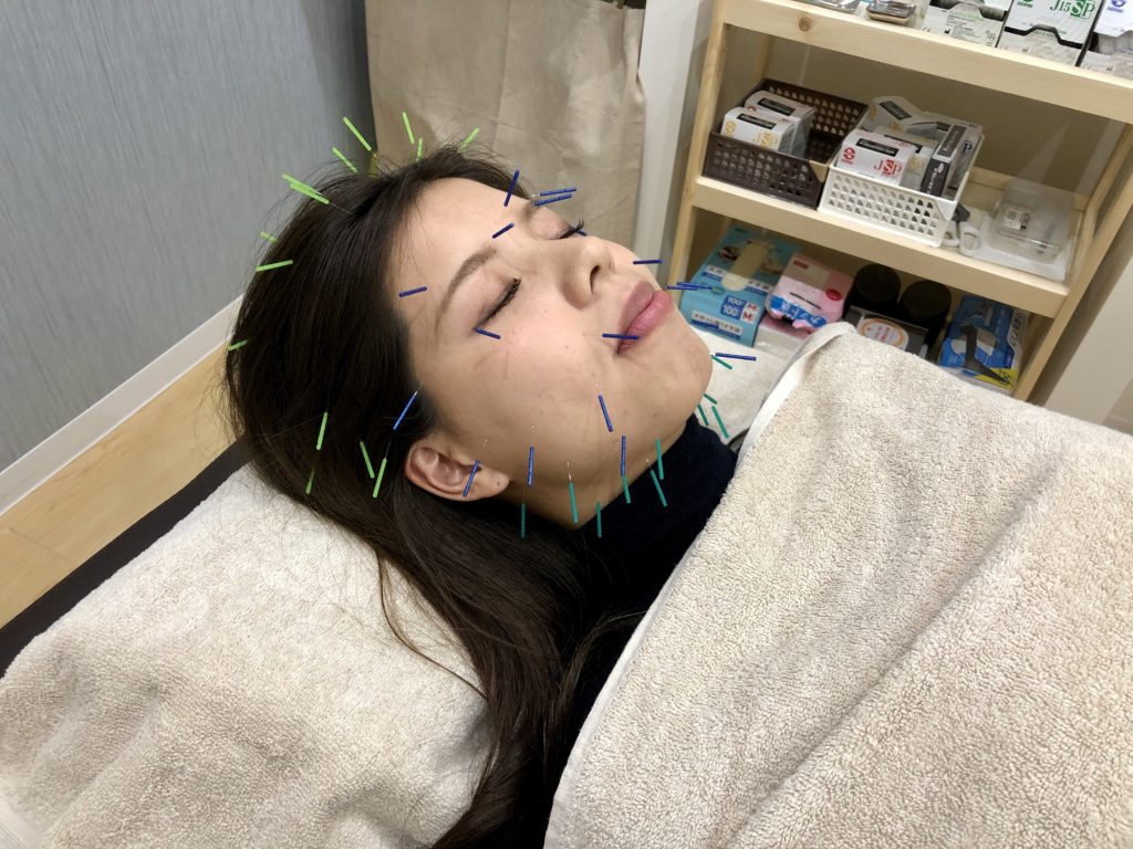 美容鍼