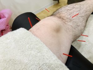 膝関節痛 鍼